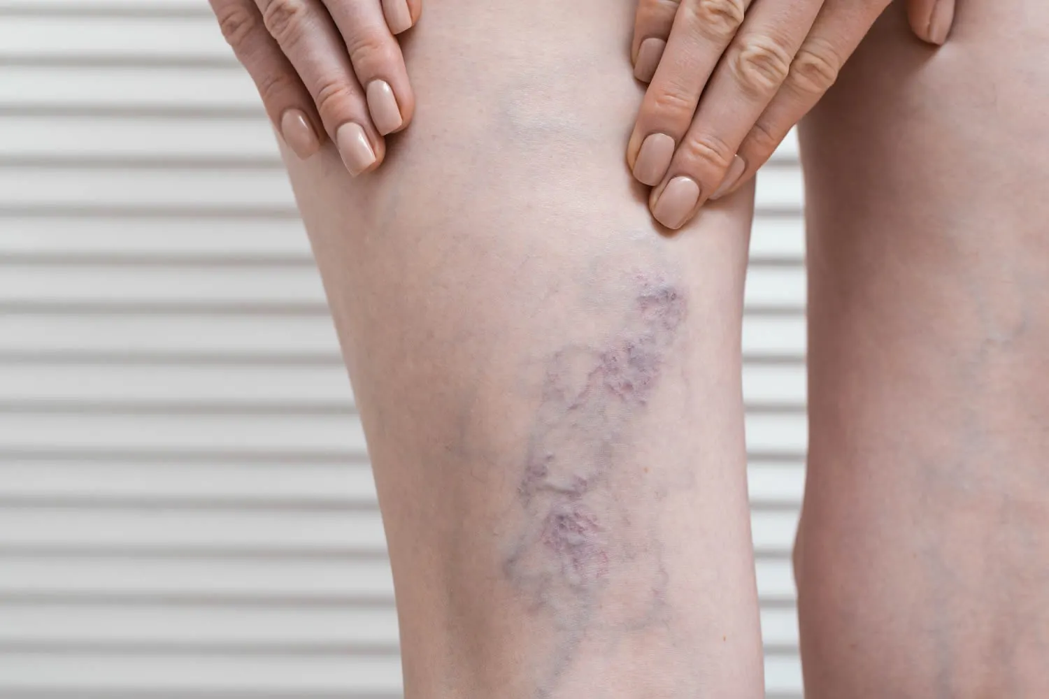 leg-with-varicose-veins-varicose-during-pregnancy