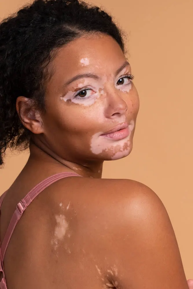 vitiligo on female face and body