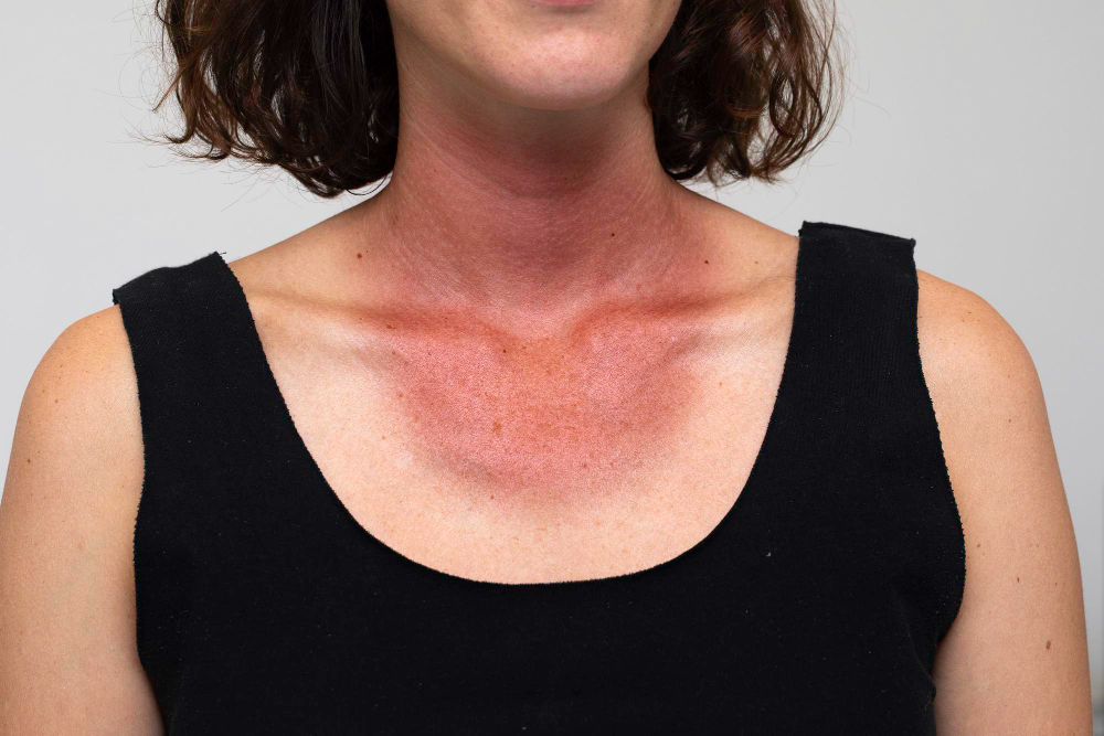 closeup-view-red-tan-line-around-neck-chest-female-risk-skin-cancer-due-wearing-sunblock-whilst-outdoors-sunlight