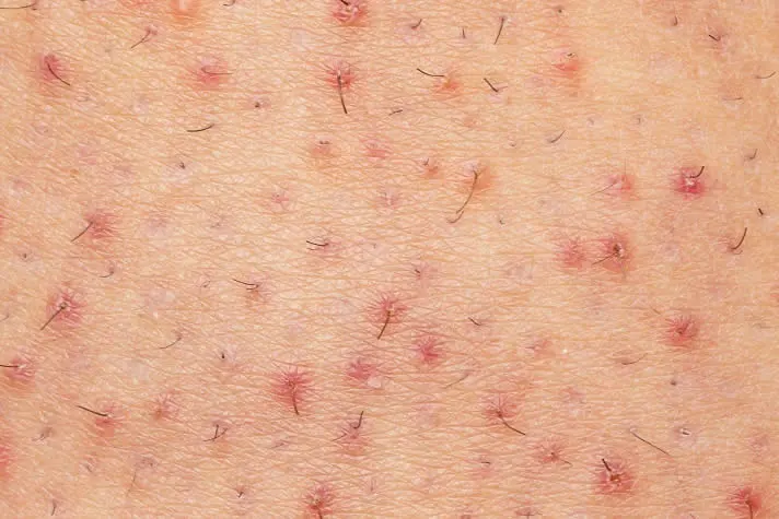skin-with-folliculitis