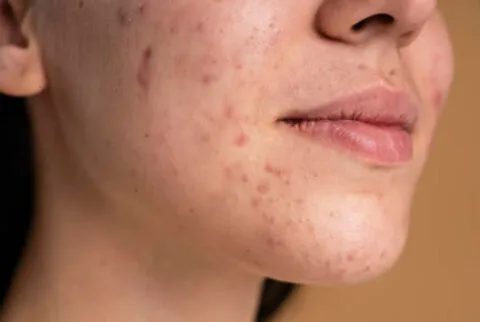 young-woman-with-acne-close-up